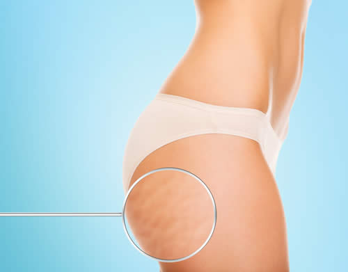 Cellulite dettaglio