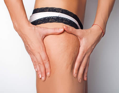 Cellulite dura e compatta