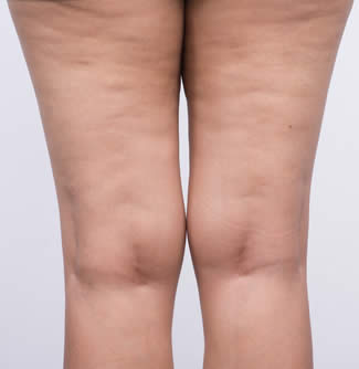 Cellulite behandlung ludwigsburg Cellulite behandlung ludwigsburg