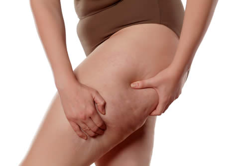 Cellulite a Materasso