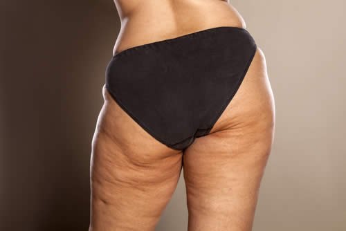 cellulite molle e flaccida