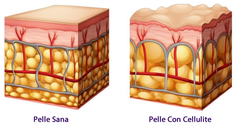 Cellulite | Cause di Origine