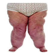 Lipedema