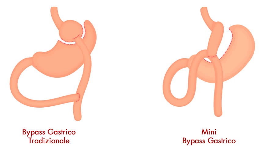 Mini Bypass gastrico