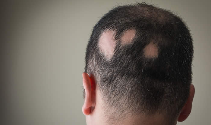 Alopecia Areata