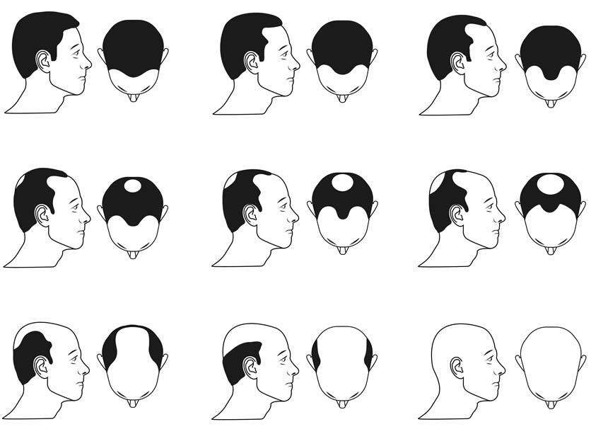 Alopecia - Grado di Gravità