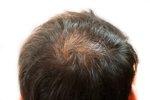 Minoxidil e Capelli | Funziona? Prezzo, ed Effetti Collaterali