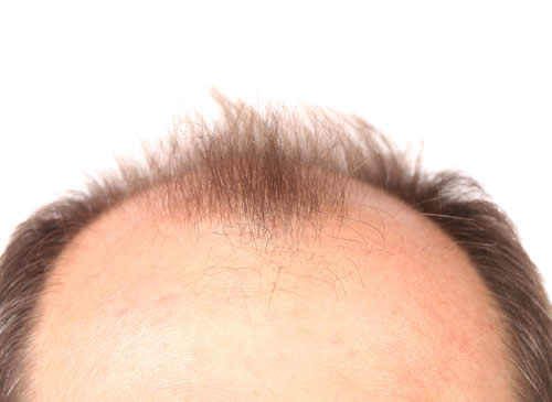 Minoxidil e Capelli | Funziona? Prezzo, ed Effetti Collaterali