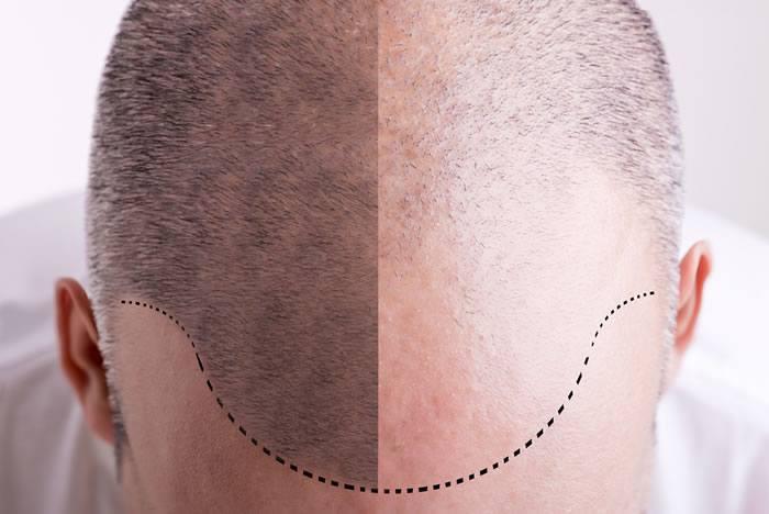 Trapianto di Capelli
