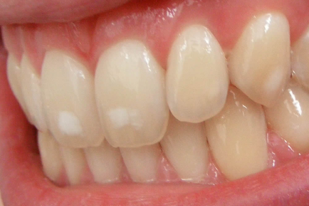 Fluorosi