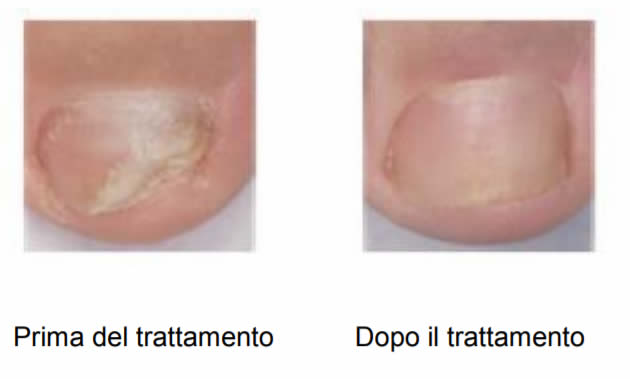 Onilaq - Foto Prima e Dopo Micosi