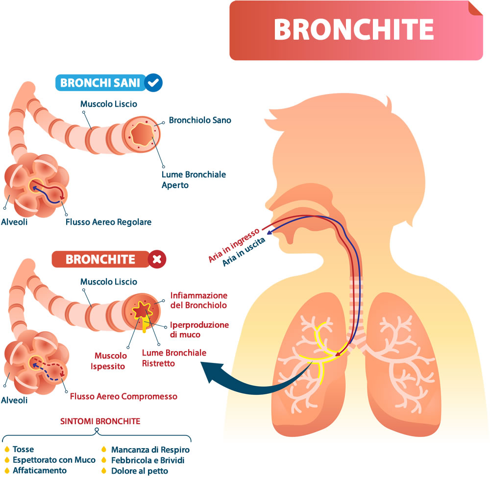Bronchite Cause