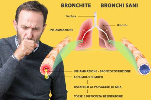 In questo articolo parliamo della Bronchite, delle sue Cause e dei Sintomi Associati. E' un Disturbo Grave? Quando Consultare il medico? Informazioni sulle Cure, i Farmaci e i Rimedi Efficaci per la Cura della Bronchite
