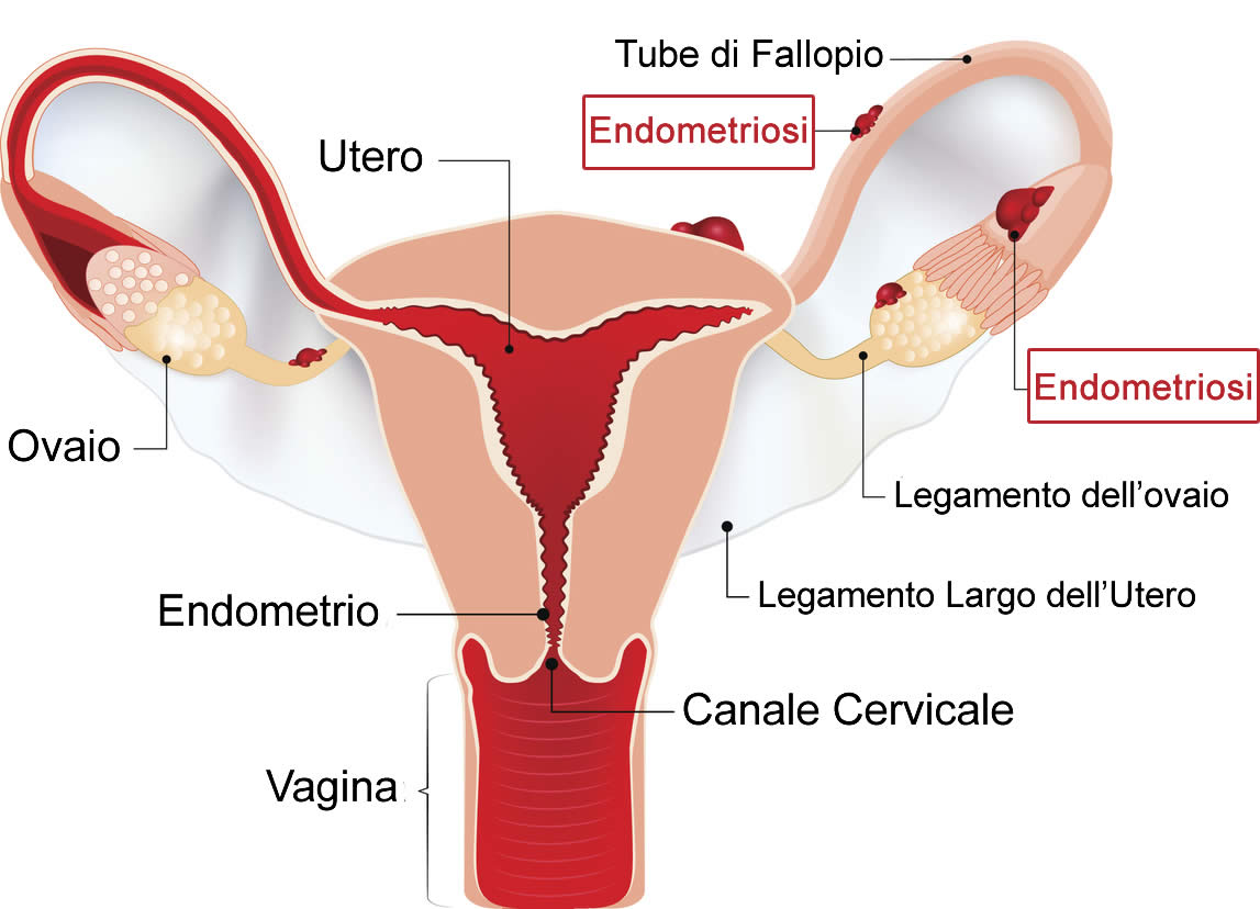 Endometriosi Utero