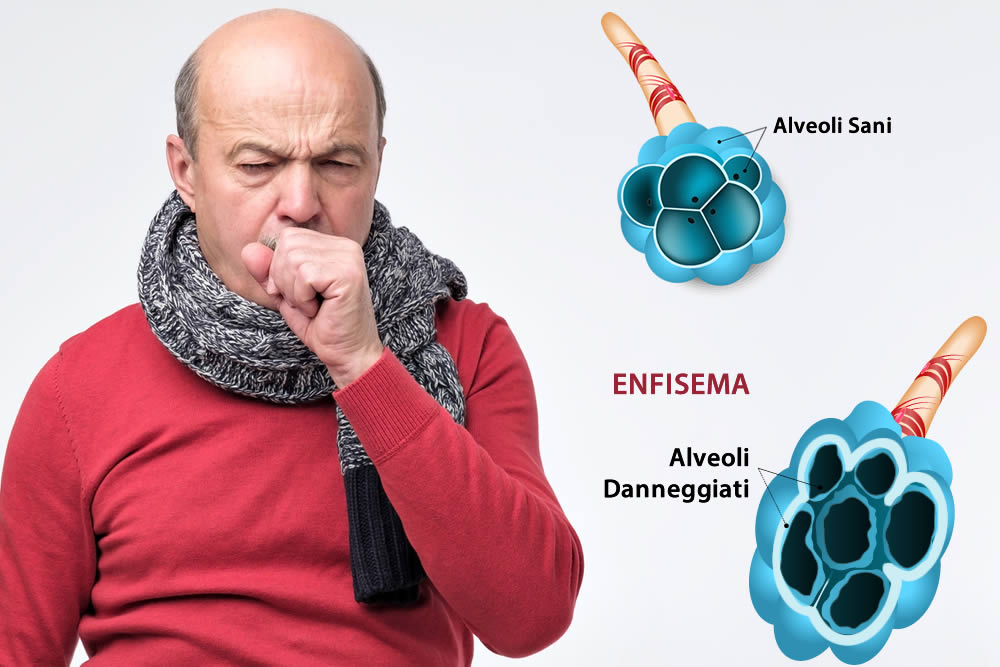 Enfisema Polmonare