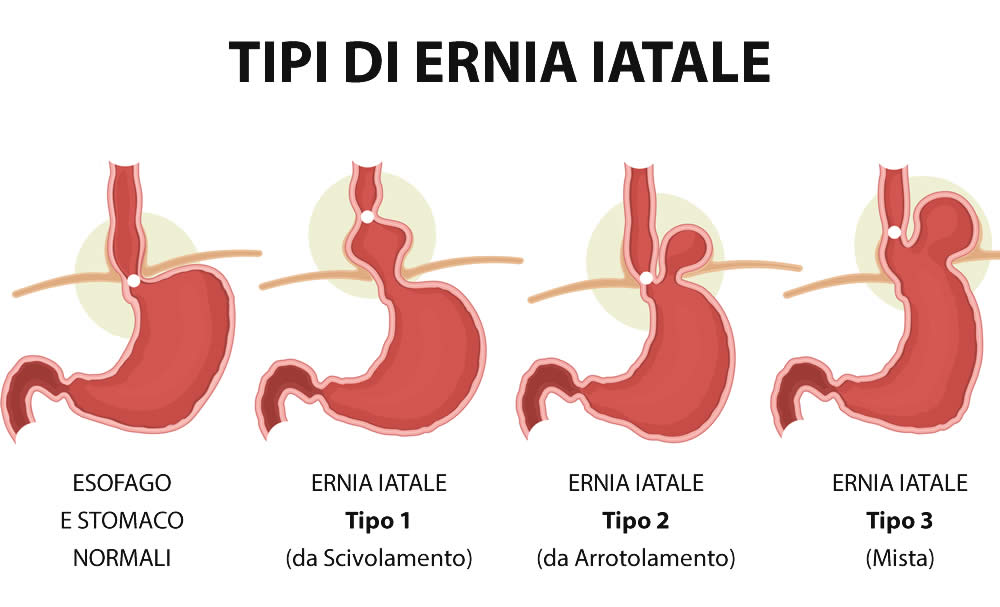 Tipi di Ernia Iatale