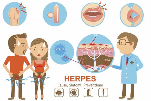 In questo articolo parliamo di Herpes Genitale, delle sue Cause e dei suoi Sintomi nella Donna e nell'Uomo. Quando Consultare il medico? Quali Esami per la Diagnosi? Informazioni sulle Cure e i Rimedi più efficaci per la Cura dell'Herpes Genitale