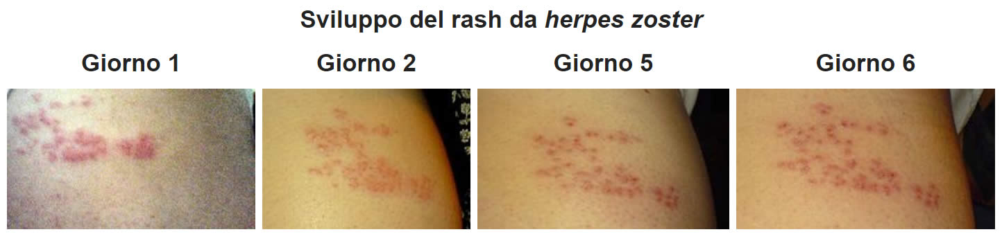 Herpes Zoster Sintomi