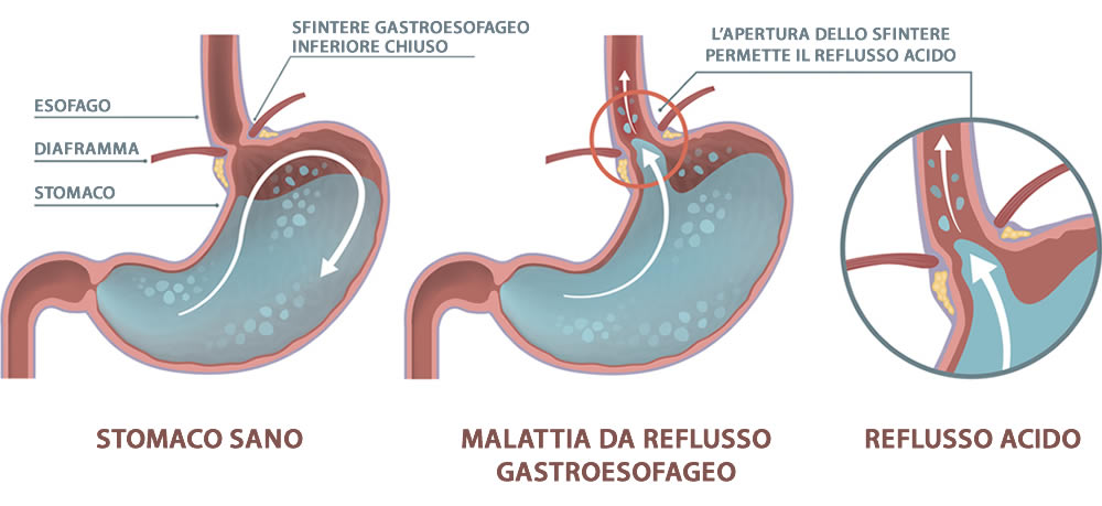 Reflusso - Stomaco ed Esofago