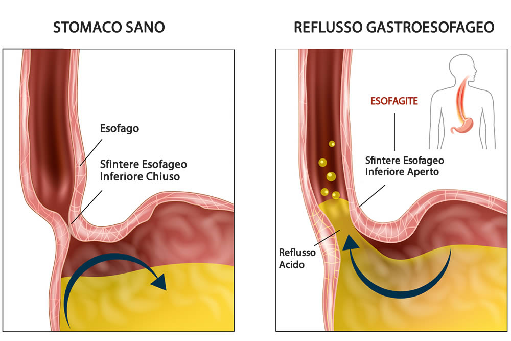 reflusso esofageo