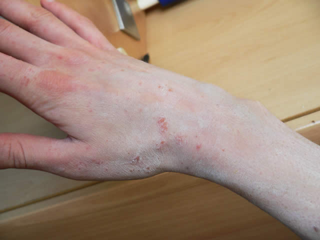 scabbia mano