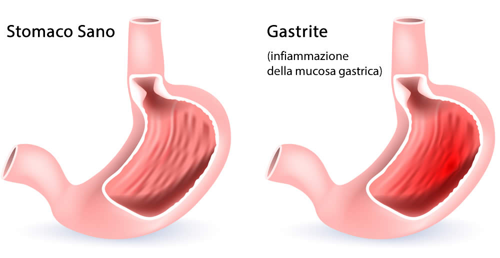 Infiammazione dello Stomaco - Gastrite