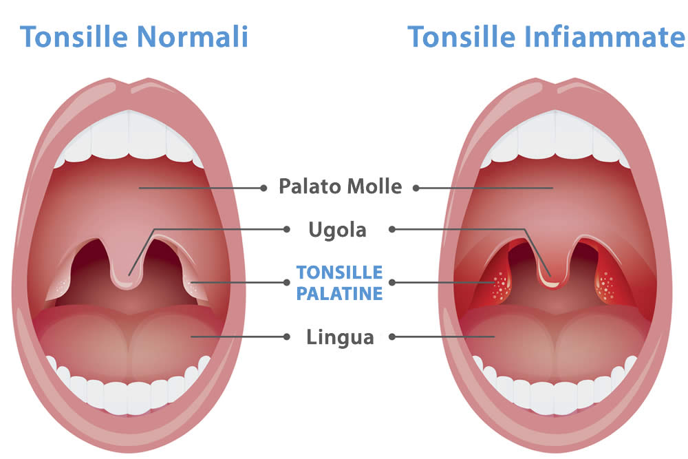Tonsille Infiammate