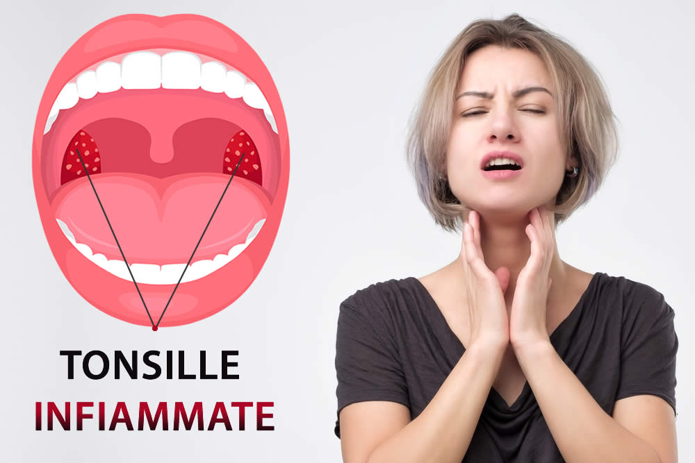 Tonsillite 2020 Cause e Sintomi Cosa Fare? Cure, Rimedi