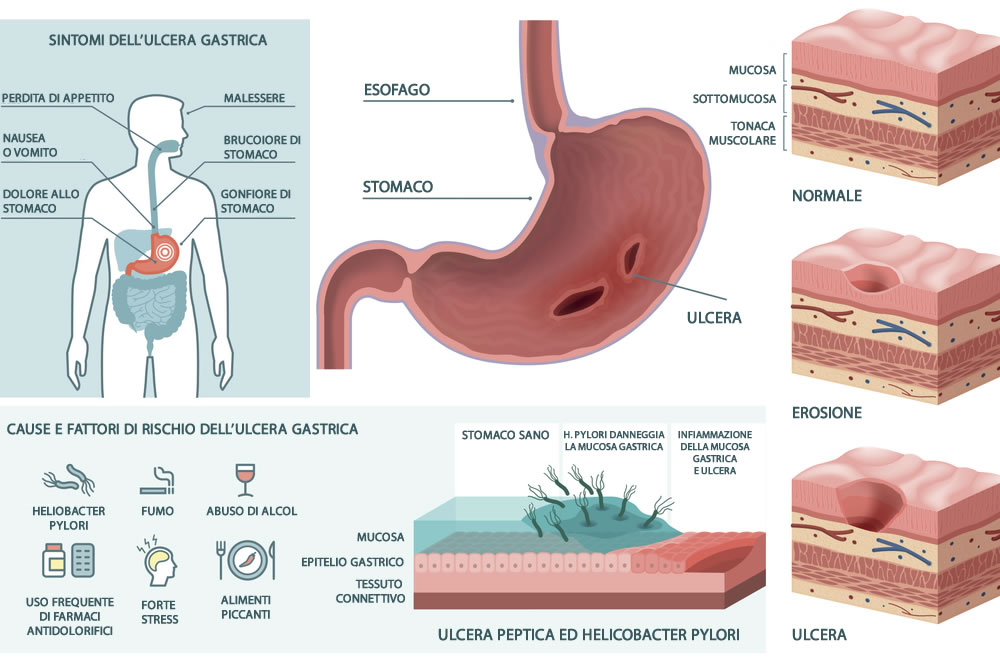 Cosa possono insegnarti gli zombi su muscoli steroidi