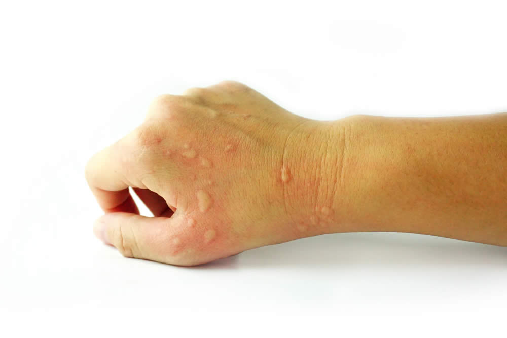 Orticaria da Stress Cause, Sintomi, Rimedi Dieta e Consigli