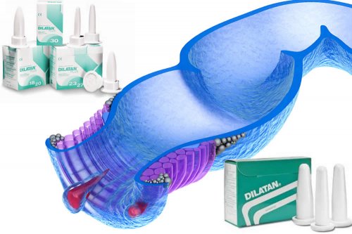 intervento prostata con dilatatore