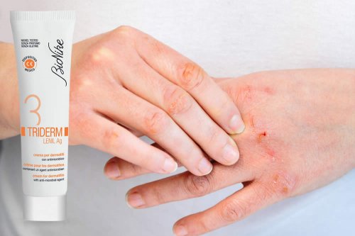In questa recensione parliamo di Triderm Lenil (dispositivo medico per il Trattamento Esterno di Dermatiti in Fase Acuta), analizzandone ingredienti, composizione, efficacia, modo d'uso, controindicazioni ed effetti collaterali